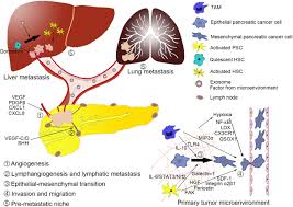 Pancreatic cancer can form in exocrine cells and neuroendocrine cells. Tumor Microenvironment Participates In Metastasis Of Pancreatic Cancer Molecular Cancer Full Text