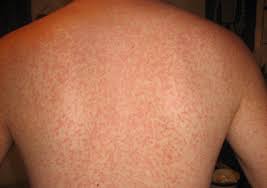 Has a rash that doesn't get better after 2 days. Viral Rash Types Symptoms And Treatment In Adults And Babies