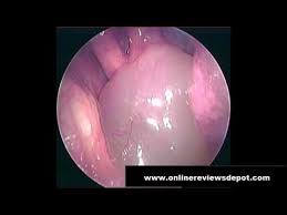 The downside to using oral medicine for nasal polyp removal is they can return when the course has finished and also steroid use has some serious. How To Remove Nasal Polyps At Home Without Surgery Shrink Nasal Polyps Naturally Without Surgery Youtube Youtube Polyp How To Remove