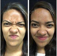 I think it really takes a week however to see the outward result of this in terms of a noticeable external difference. How Long Does It Take For Botox To Work The First Time Facial Injections Info Prices Photos Reviews Q A