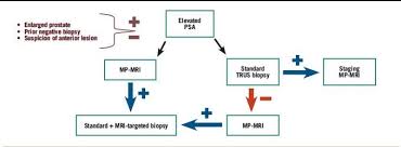 Tests to diagnose and stage prostate cancer. When To Order An Mri In The Initial Evaluation And Management Of Prostate Cancer