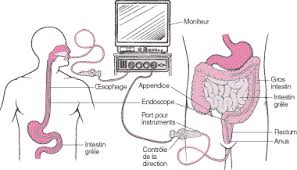 C'est un examen qui se pratique en ambulatoire, le plus souvent sous une courte anesthésie locale. Hepato Gastro Enterologie Et Endoscopies Digestives Centre Hospitalier Des Quatre Villes