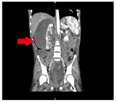 Image result for Perinephric Abscess