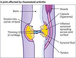 Rheumatoid arthritis (ra) is a chronic, progressive, and disabling autoimmune disease. Rheumatoid Arthritis Causes Symptoms Treatments