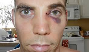 Steve O Broken Nose Via Mike Tyson Punch Smitttest