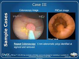 4 with colon cancers, 1 with gastric cancer and 1 with a small bowel cancer. Ppt Pillcam Colon Powerpoint Presentation Free Download Id 5784543
