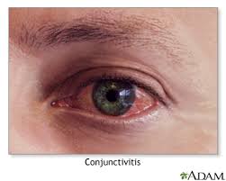 Image result for Allergic Conjunctivitis