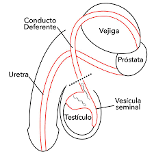 Que Es Una Vasectomia