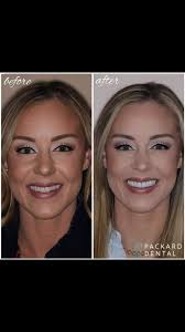 Yay or nay? These Invisalign results are outstanding. This young lady in  her mid-20s decided to do something about her cricket teeth. What do you  think about these results