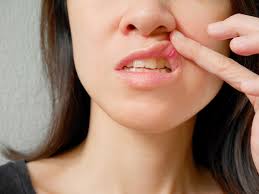 They may be primary or recurrent infections. What Are The Different Types Of Canker Sores