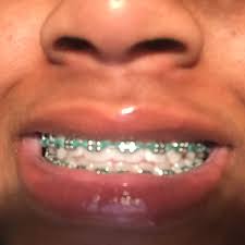 Follow T I N Y Y For More Braces Colors Cute Braces Dental Braces Colors