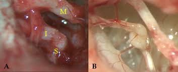 Image result for Ossicular Chain Disruption