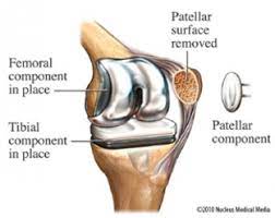 Totalkneereplacementsurgery Image2 Total Knee Replacement Knee Replacement Knee Implants
