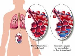 Pneumonia is an infection of the lungs with a range of possible causes. Pneumonia What You Need To Know University Health News