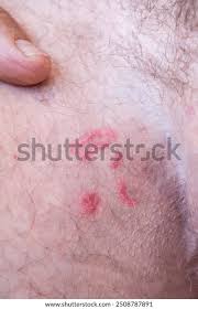 Image result for scabies in the groin area