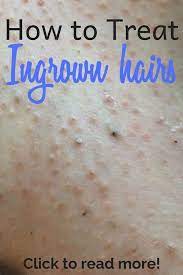Ingrown hairs are a pesky skin problem that occur after shaving, plucking, tweezing, threading, or waxing hair. Pin On My Saves