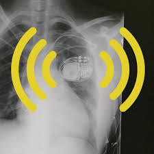 Pacemakers are fairly easy to implant. My Pacemaker Is Tracking Me From Inside My Body The Atlantic