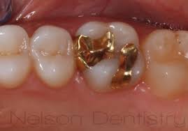 We did not find results for: Gold Inlays Before And After Missoula Dentist