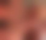 Image result for Rectal prolapse