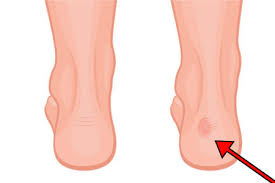 In some instances, haglund's deformity can lead to bursitis, a more serious condition. The Best Shoes For Haglund S Deformity Extra Cushion And Extra Depth Comfortable Women S Shoes