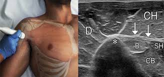The three parts of the pm are attached to the anterior aspect of the medial half of the clavicle, the anterior part of the sternum, and the cartilages of all the true ribs. Us And Mr Imaging Of Pectoralis Major Injuries Radiographics