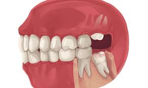 Image result for Tooth Extraction