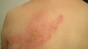 Herpes zoster / shingles)، هو التهاب فيروسيّ حاد في العصب وسطح الجلد المُحيط به الذي يُغذّيه هذا العصب، إذ يظهر على هيئة حويصلات في مسار عصب حسيّ مُعيّن، ويتميّز بوجود ألم شديد، وهذا سبب تسميته بالحزام الناريّ، حيث إنّه يأخذ جزءاً مُحدّداً من الجلد تِبعاً للعصب المُصاب وكأنّه حزام يفصل هذا الجزء شديد الألم وأحمر اللّون كالنّار عن باقي الجسم. ØªØ£Ø«ÙŠØ± Ø§Ù„Ø­Ø²Ø§Ù… Ø§Ù„Ù†Ø§Ø±ÙŠ Ø¹Ù„Ù‰ Ø§Ù„Ø­Ø§Ù…Ù„ ÙˆØ§Ù„Ø¬Ù†ÙŠÙ† ÙˆÙƒÙŠÙÙŠØ© Ø¹Ù„Ø§Ø¬Ù‡ Ø§Ù„Ù…Ø±Ø³Ø§Ù„