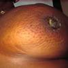 Moreover, this sort of cancer also changes the look of your breasts. 1