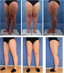 Operationen Bei Lipodem Lymphcare