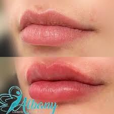 Best Lip Fillers In Edmonton Cost Results Safety Albany