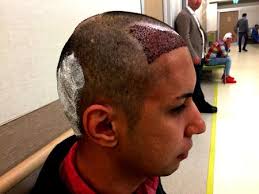 These can result in damaged hair. Turkey S Hair Transplant Tourism Industry Is Unsafe For Patients And Takes Advantage Of Syrian Refugee Workters Quartz