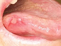If you choose to drink alcohol, do so in moderation. Early Detection Of Mouth Cancer Improving Success 2019 Goccles