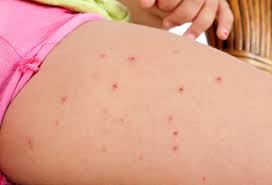 Acne pimples are common and can affect anybody zits on buttocks are a common sign of sexually transmitted diseases. Boils Pictures Causes Symptoms And Treatment