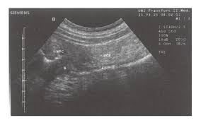 Image result for Neutropenic Colitis