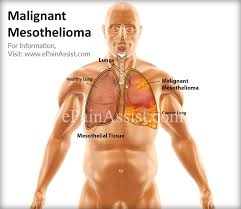Image result for Malignant mesothelioma