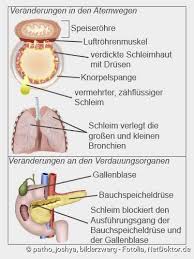 Mukoviszidoseim ersten teil des podcasts erfahrt ihr das wichtigste über die pathophysiologie, diagnostik und komplikationen bei der mukoviszidose.das. Mukoviszidose Beschreibung Symptome Behandlung Verlauf Netdoktor