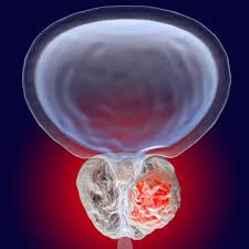 Prostate cancer can be classified into four different stages … Prostate Cancer Diagnosis Johns Hopkins Medicine