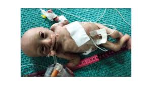 See full list on diffen.com Dwarfism Types Causes And More