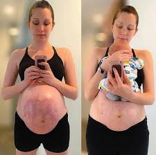 How To Get Rid Of Stretched Skin After Pregnancy Extensive Answer