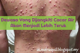 Dr tu ada tanya pernah kena chicken pox tak sebelum ni?sebab orang yang pernah kena. Tanda Awal Chicken Pox Cara Membuat Krim Sapuan Untuk Demam Chicken Pox Home Remedies For Chicken Pox Including Recipes Rahmatidris