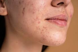 Hampas timun kemudian dijadikan sebagai masker dan dibiarkan selama 30 minit. Nyesel Baru Tahu Ternyata 4 Cara Menghilangkan Bekas Jerawat Ini Mudah Seperti Menjentikkan Jari Tangan Yuk Cari Tahu Semua Halaman Nakita