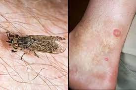Along with some pain and swelling at the bite site, the. Insect Bites And Stings Symptoms Nhs