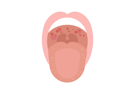 Image result for Physical injury red spots roof of mouth