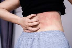 Image result for sweat rash on back