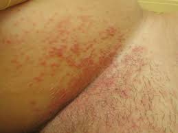 Intertrigo home remedies include lemon as it is easily available home remedy that may help treat intertrigo symptoms such as rashes, itching and irritation. Candidosis Intertriginous Altmeyers Encyclopedia Department Dermatology