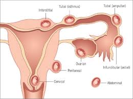 Medication an early ectopic pregnancy without unstable bleeding is most often treated with a medication called methotrexate, which stops cell growth and dissolves existing cells. Article On Ectopic Pregnancy Standard Of Care