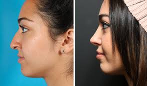 Also known as rhinoplasty, the nose job is one of many surgeries that charge the patient very much based on many factors and, compared to the lasik eye surgery cost. Rhinoplasty Toronto Nose Job Cost Ontario Dr Asaria