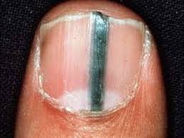 Haben Sie Diesen Streifen Auf Dem Fingernagel Ist Es Gefahrlich Youtube