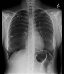Ultrasound imaging also may be used to identify a pneumothorax. Percutaneous Catheter For Spontaneous Pneumothorax Ctsnet