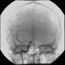 Los aneurismas cerebrales se forman como resultado del adelgazamiento de las paredes arteriales. Embolizacion De Aneurismas Y Fistulas Cerebrales